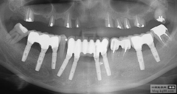 黑龍江隱形義齒 黑龍江隱形義齒