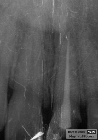 黑龍江隱形義齒 黑龍江隱形義齒