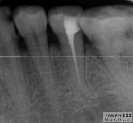 黑龍江隱形義齒 黑龍江隱形義齒