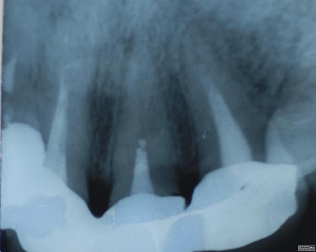 佳木斯隱形義齒 佳木斯隱形義齒
