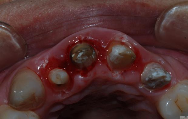 佳木斯隱形義齒 佳木斯隱形義齒