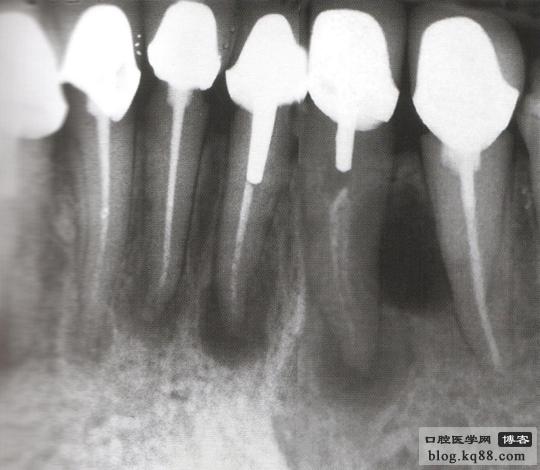 佳木斯隱形義齒 佳木斯隱形義齒
