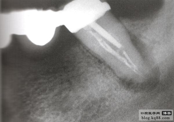 佳木斯隱形義齒 佳木斯隱形義齒